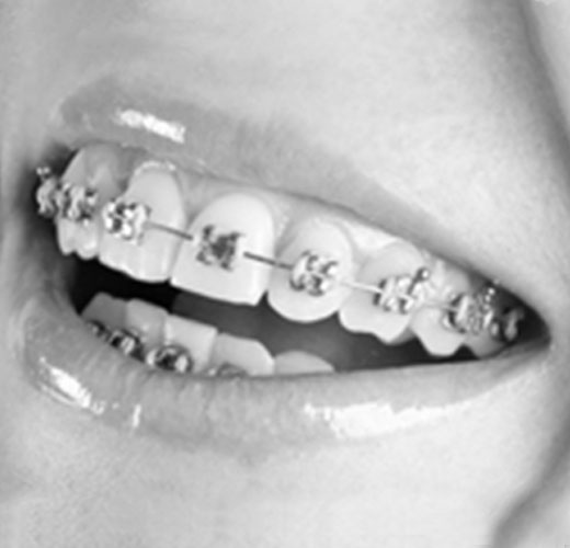 metal_braces